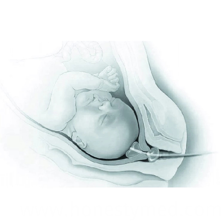 China disposable dilatation cervical ripening balloon catheter